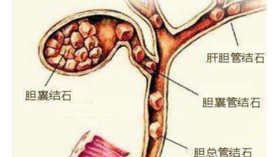 膽囊結(jié)石可以不切膽嗎？