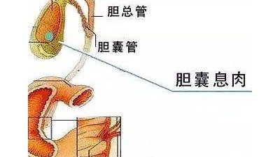 得了膽囊息肉怎么辦，如何治療？