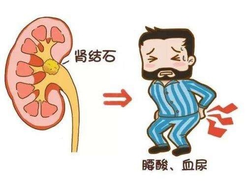 得了腎結(jié)石怎么辦？